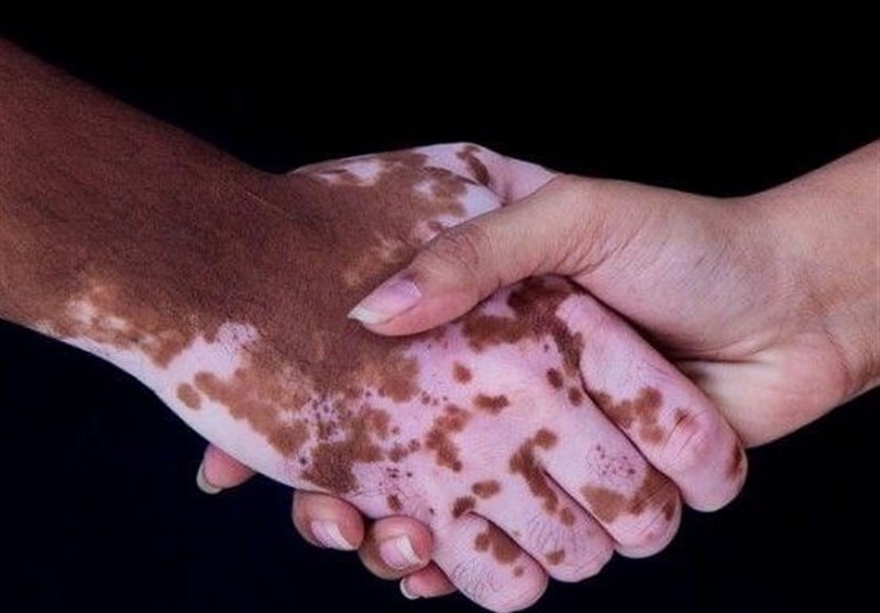 سلول‌های بنیادی به کمک بیماران پیسی آمد؛ یک سال درمان موفق در شیراز