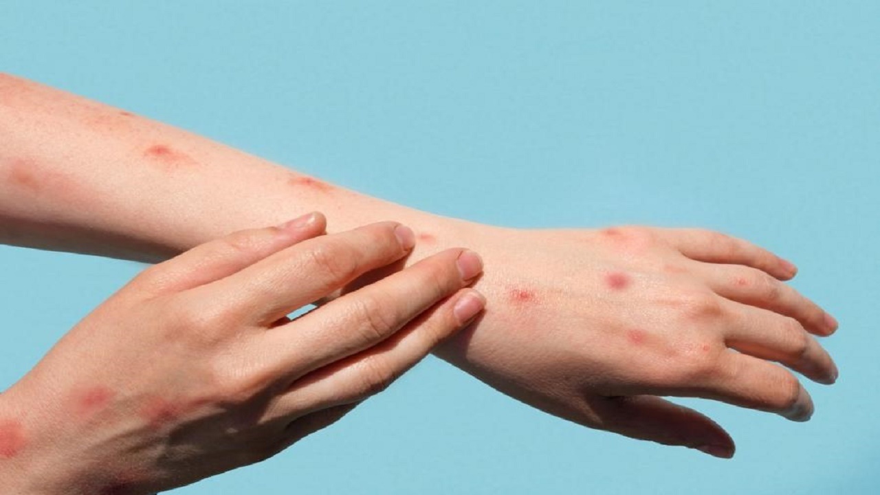 باور غلط رایج درباره عفونت‌های چرکی پوست؛ بهداشت شخصی تنها عامل نیست
