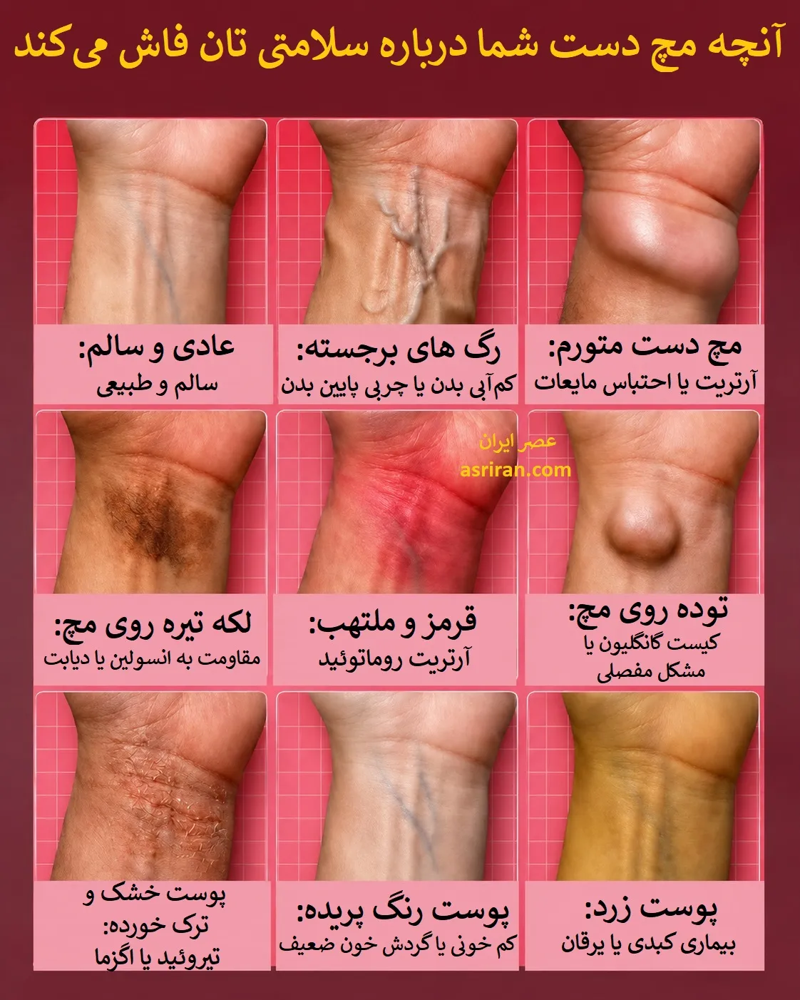 نشانه‌هایی از بیماری که مچ دست شما فاش می‌کند