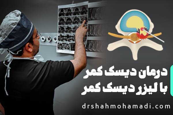 درمان دیسک کمر بدون جراحی باز؛ هر آنچه باید درباره لیزر PLDD بدانید