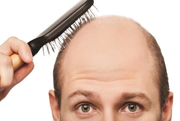 قرص التهاب مفاصل به کمک فولیکول‌های مو آمد؛ رویش ۹۰ درصدی در بیماران طاسی شدید